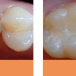 dental fillings before and after Brisbane