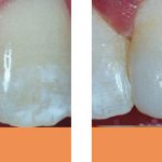 Brisbane dental fillings before and after dentist