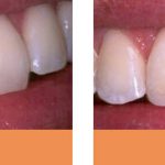 dental fillings before and after Chermisde Dentist