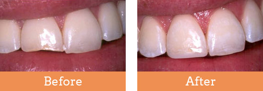 Dental Before and After Brisbane | Smile Perfection Dental