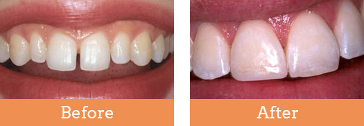 Dental Before And After Brisbane 