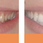 veneers before and after teeth whitening before and after Dentist Brisbane Chermside