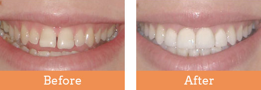 Dental Before and After Brisbane | Smile Perfection Dental