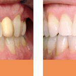 teeth whitening before and after tooth crowns before and after Brisbane Dentist