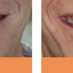 replacement denture before and after dentist Brisbane Chermside