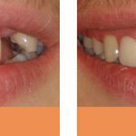 replacement upper partial denture before and after dentist Brisbane