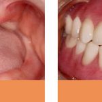 complete dentures before and after Brisbane