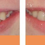 Composite dental bridges before and after Brisbane