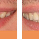 Porcelain veneers before and after; crown before and after Brisbane