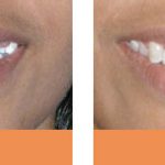 Braces before and after dental implants before and after Brisbane